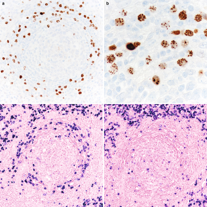 Four micrographs highlight plasmablasts with a granular nuclear pattern under high and low magnification. Immunolabeling reveals high stain uptake for lambda and a little less for kappa.