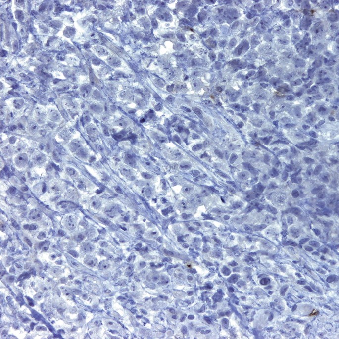 A micrograph reveals the almost NIL uptake of the B-cell marker C D 30 in a case of large B-cell lymphoma.