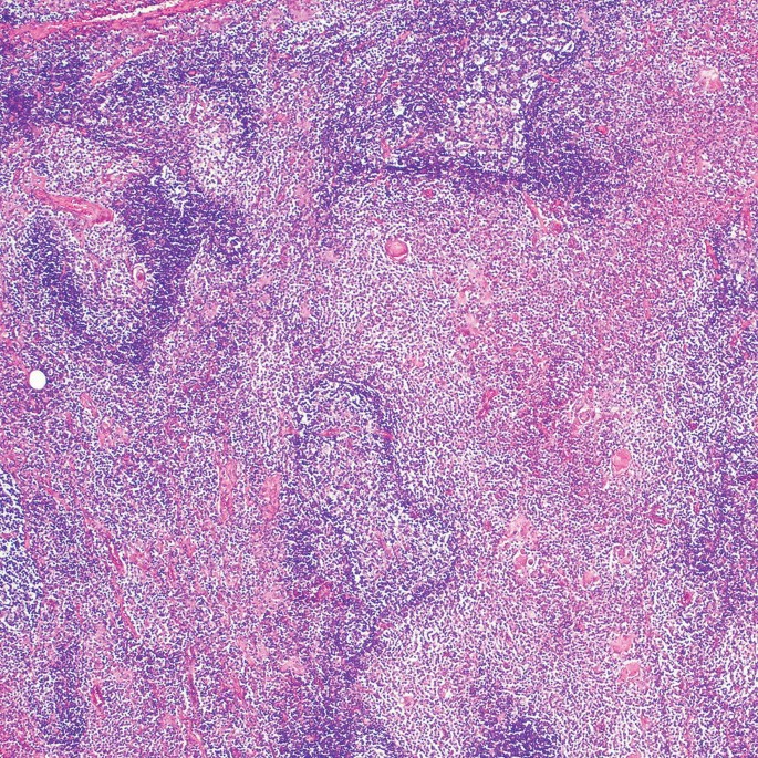 A low-magnification micrograph highlights the high invasion and increased vascularity with some distorted lymphoid follicles.