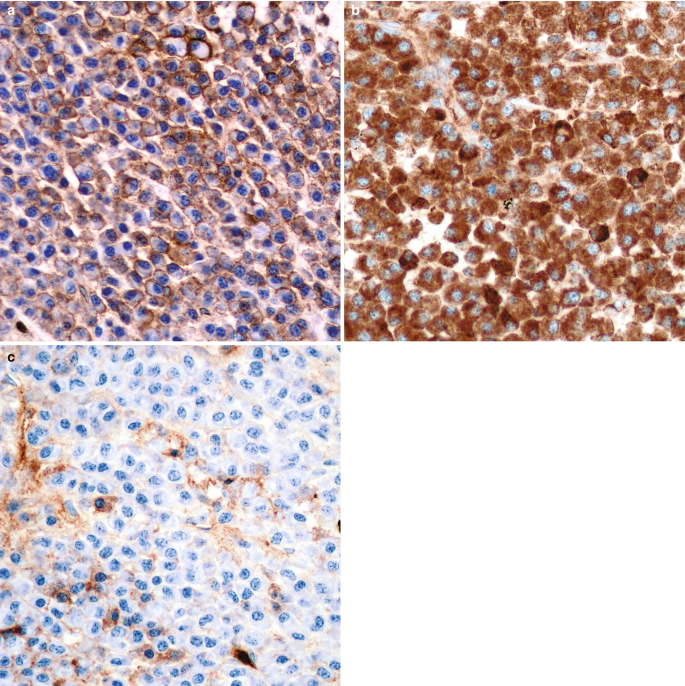 Three micrographs for three markers. C D 138 and kappa light chain are moderate extracellular and high throughout while lambda light chain is almost zero.