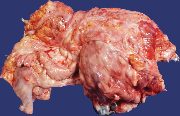 A photograph of a fleshy biopsy mass highlights the presence of a large anterior mediastinal mass and generalized lymphadenopathy.