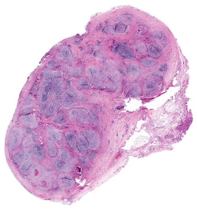 A micrograph depicts a panoramic view of a lymph node thickened with bands of fibrosis. It contains lymphocytes, eosinophils, neutrophils, plasma cells, and macrophages.