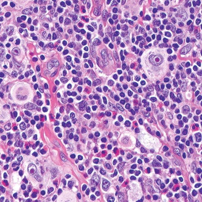 A micrograph highlights the absence of fibrosis and the separation of tissue into cellular nodules against an inflammatory background.