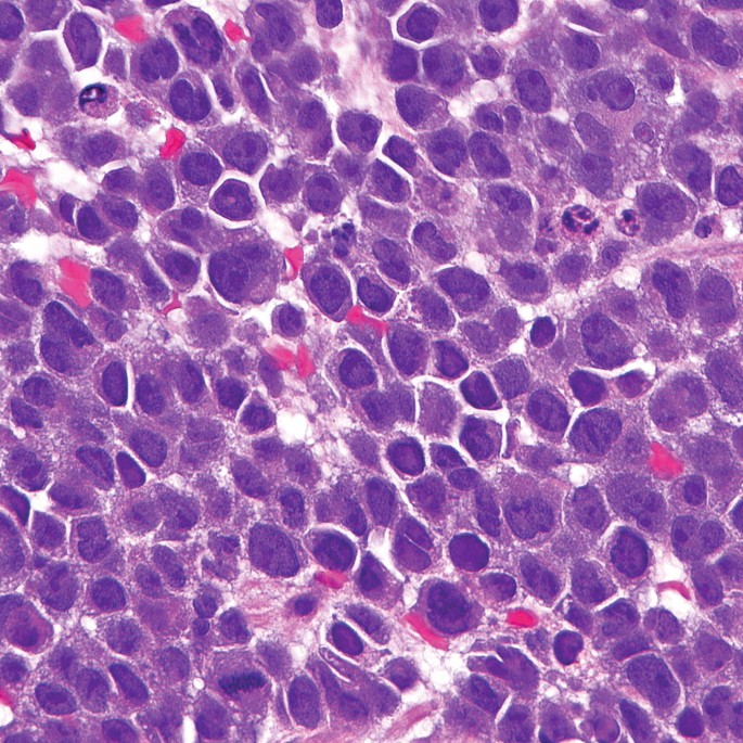 A micrograph exhibits large blasts in monocytic sarcoma with a reniform or cleaved nucleus and moderately amphophilic to eosinophilic cytoplasm.