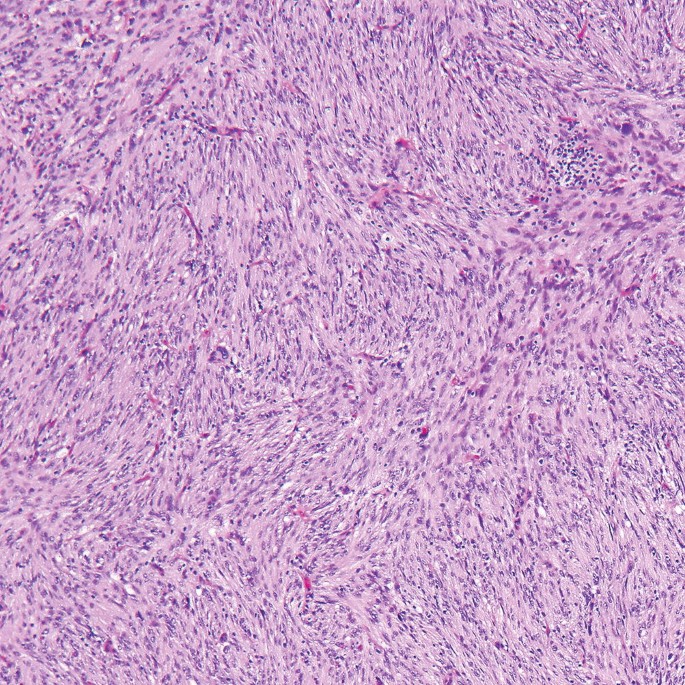 A micrograph reveals a multilobulated tumor with follicular dendritic cell growth and lymph node effacement.