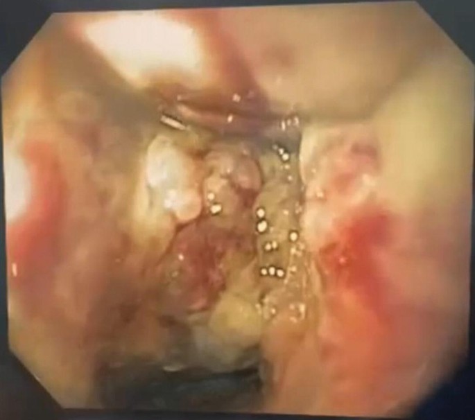 A close-up endoscopic view of a gastrointestinal fistula of a human.