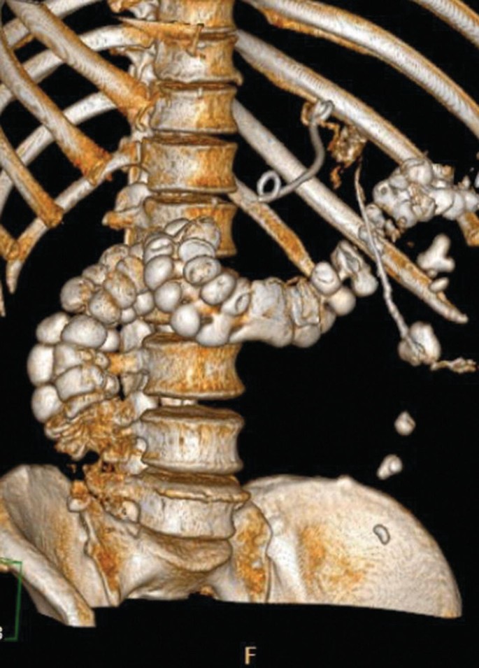 A 3-dimensional C T scan of the abdominal cavity of a human with a pigtail catheter attached to the ribs.