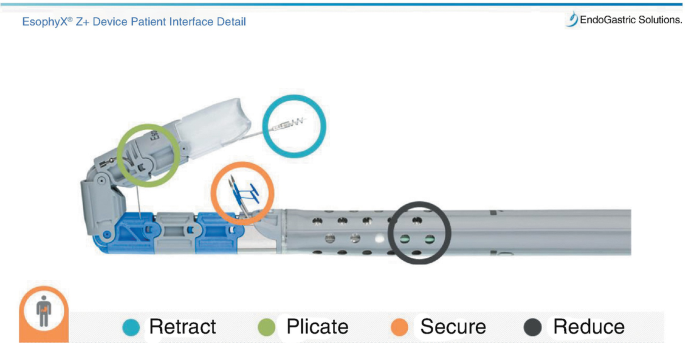 A diagram of an Esophy X Z plus device with its parts used for various purposes. Retract is used to grasp the tissue, plicate is used to rotate the tissue, secure is used to fire the tissue, and reduce is used to reduce small Hiatal hernias.