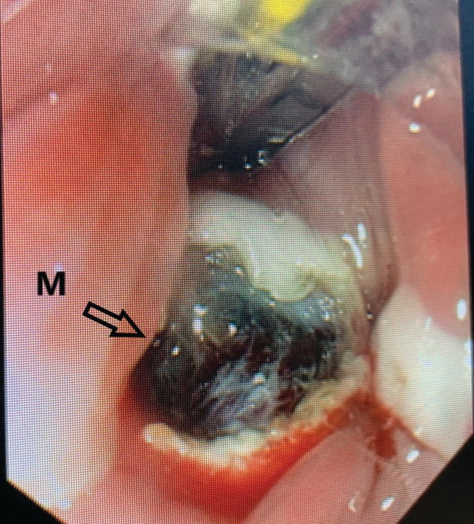 A photo of mucosotomy on the septum. The area is labeled, M.