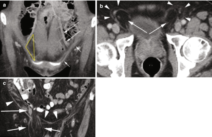 3 C T images of the pelvis region. a. A coronal C T image has markings of long arrows, short arrows, and a yellow triangle. b. An axial C T image has markings of arrows and arrowheads. c. A coronal C T image has markings of long arrows and arrowheads.