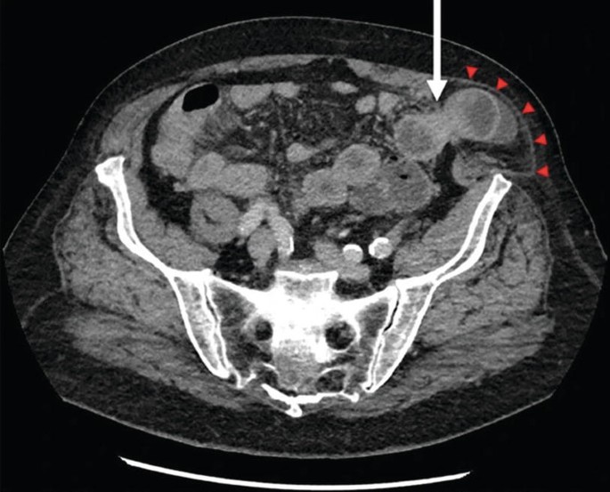 An ultrasound of a left-sided spigelian hernia with an arrow at the top facing downward and five triangles adjacent to each other on the top right.