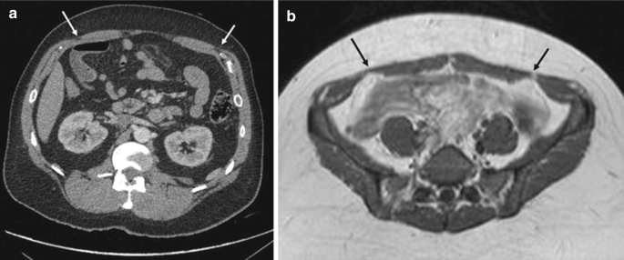 2 images of radiographs. A, is the cross-sectional view with arrow at left and right top. B, cross section M R I image with arrows at the top left and right.