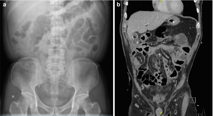 2 Scanned images. A. An X-ray image and B. a C T image of the coronal view of the abdomen focusing on the distention of the entire small bowel.