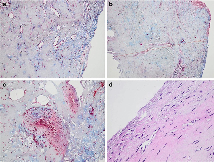 4 micrographs of the peritoneal region exhibit loosely packed flat and thin cells with a darkly stained region, indicating the spread of fibrosis.