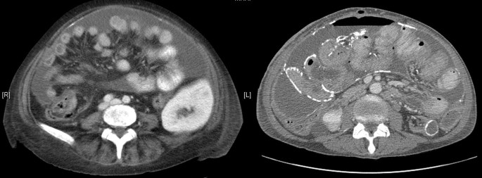 Two C T scans of the abdomen. Image A exhibits a thickened peritoneal region with calcium deposits, indicating an obstructed gut, and image B denotes a normal functioning kidney.