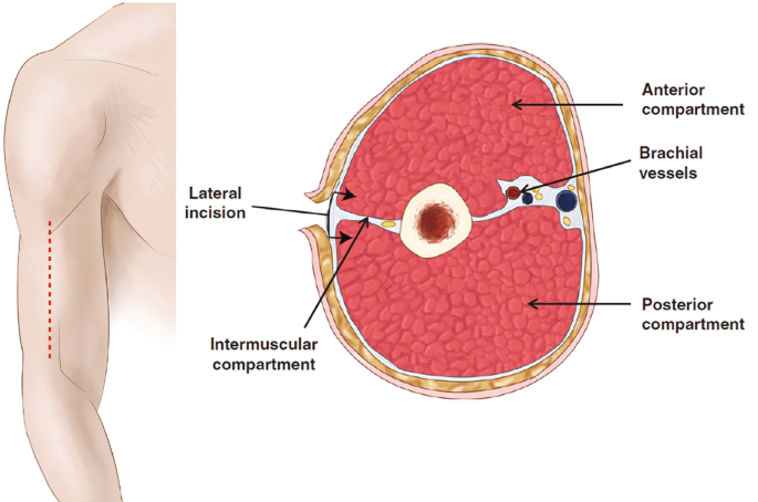 2 illustrations. 1, is of the upper arm with a line drawn from the end of the bicep to the elbow. 2, is an illustration with anterior and posterior compartments, brachial vessels, intermuscular compartments, and lateral incisions labeled.