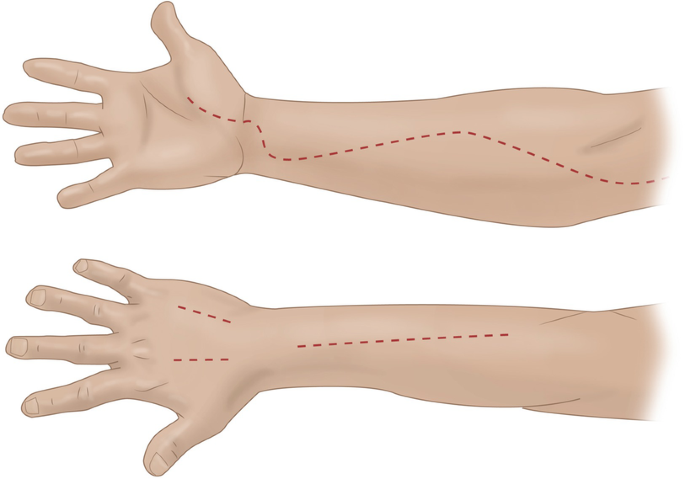 An illustration of the palmar and dorsal surface of an arm. A curved line is marked from the palm to the elbow. 3 lines are drawn on the dorsal surface of the arm.