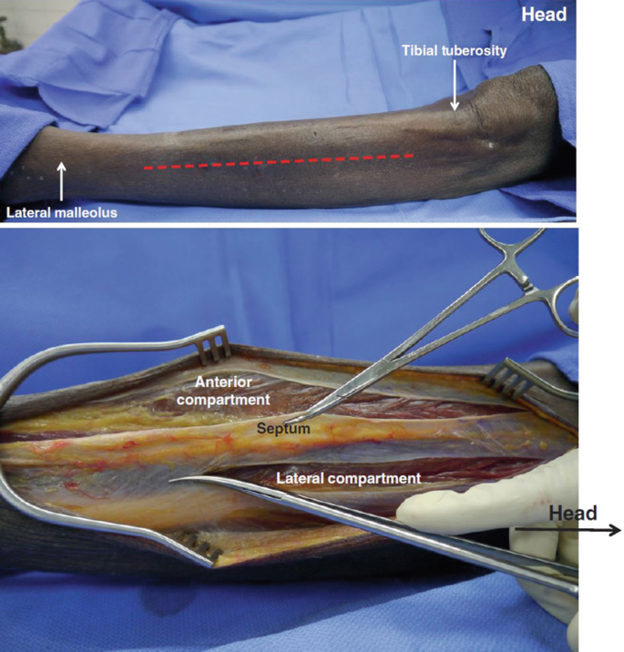 2 photographs. 1, represents the lower leg with tibial tuberosity and lateral malleolus labeled. 2, represents the laterally incised lower leg. The anterior compartment, septum, and lateral compartment are labeled.