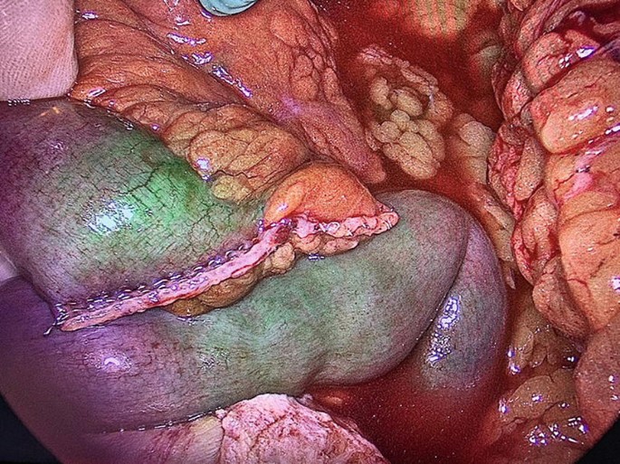 An endoscopic view of the stained intestinal organ. Some intestinal regions appear normal in the shade of the skin and other appear discolored and stained in a pool of blood.