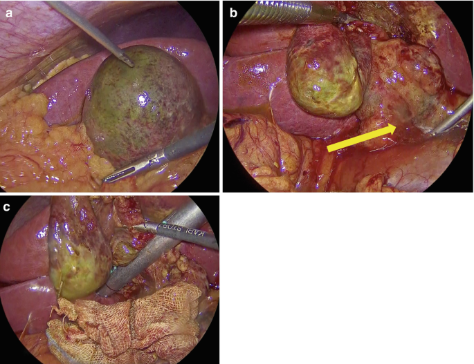 Three intraoperative photos of an organ. The organ appears large, swollen, and discolored. Photos A, B, and C. The surgical instruments are on the organ, on the right, and underneath it, respectively.