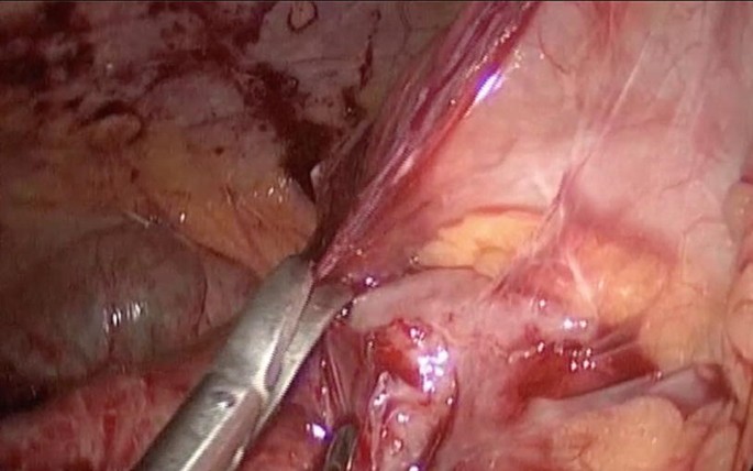 An intraoperative photo of the intestine. A pair of surgical scissors pull a dark muscle layer.