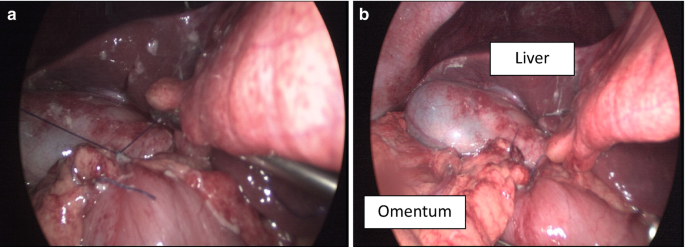 2 photos of laparoscopic surgery for an ulcer. A. A photo of sutures. B. A photo of the omental patch repair. Liver and omentum are labeled.