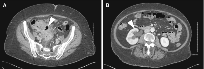 Two ultrasound photos of the small intestine area. The inflammations are visible in the acute abdominal area.