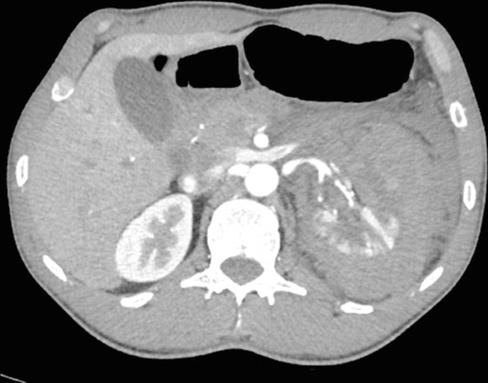 An S E Q image of renal injury indicates the severity at A A S T grade five.