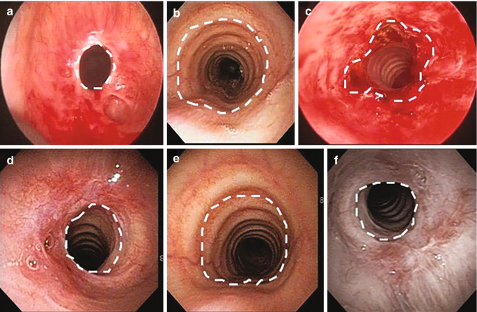 6 bronchoscopic photographs. a. A dashed line circle marks the hole. b. A deep hole with layers and a dotted line circle marks the wide opening. c. An opening with an uneven shape is marked with dashed lines. d. A round medium-sized opening is marked and layers are viewed inside. e. Big layers are visible inside the hole in e, while small in f.