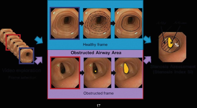 An illustration of computer vision center photographs. The airway path has multiple layers in healthy frame while a hole with a small opening is observed in the obstructed frame.