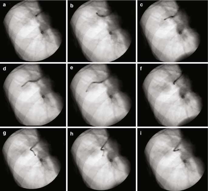 9 biplanar fluoroscopy scans, a through i, illustrate different tracks of a darkly shaded path for diagnosis of the pulmonary lesions.