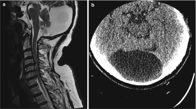 One M R I and one C T scans. 1. A M R I scan of retrocerebellar area reveals hyperintense cystic collection. 2. C T scan of the cerebellum has a dark region surrounded by a narrow light region.