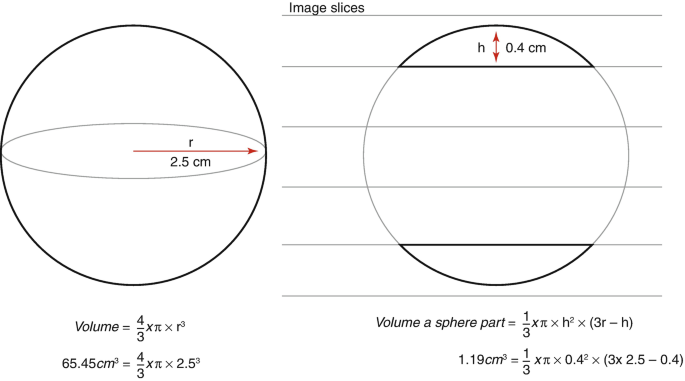 Two circle diagrams depict cyst volume. On the left, the radius of the circle is measured, r equals 2.5 Centi meters. Below the circle the values are Volume equals 4 by 3 pi r square, volume equals 65.45 c m cube equals 4 by 3 pi 2.5 power three. On the right, the height of the circle is placed on a horizontal lined plane where h equals 0.4 centimeters. Below the circle, volume a sphere part equals 1 by 3 pi h power 2 into 3 r minus h, 1.19-centimeter cube equals 1 by 3 pi into 0.4 power 2 into 3 into 2.5 minus 0.4.