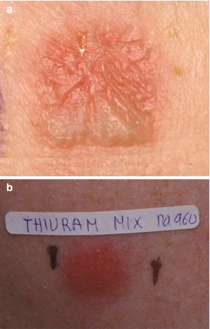 Diagnostic Tools to Use When We Suspect an Allergic Reaction to a Tattoo: A  Proposal Based on Cases at Our Hospital