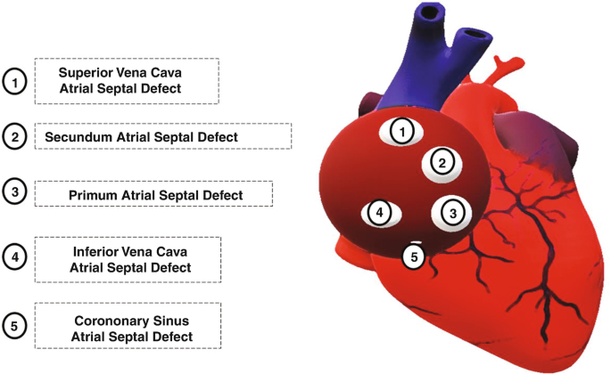 What is crochetage sign in atrial septal defect? 