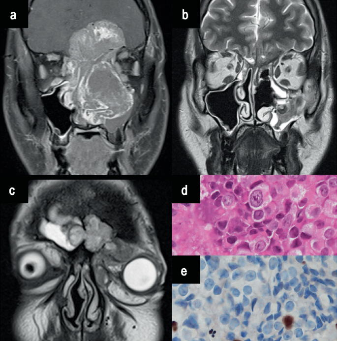 A set of five images of Sino nasal pathologies depicts inflammatory to neoplasms indicating Sino nasal undifferentiated carcinoma to a specific molecular identifier and definitive chemoradiation with complete response.