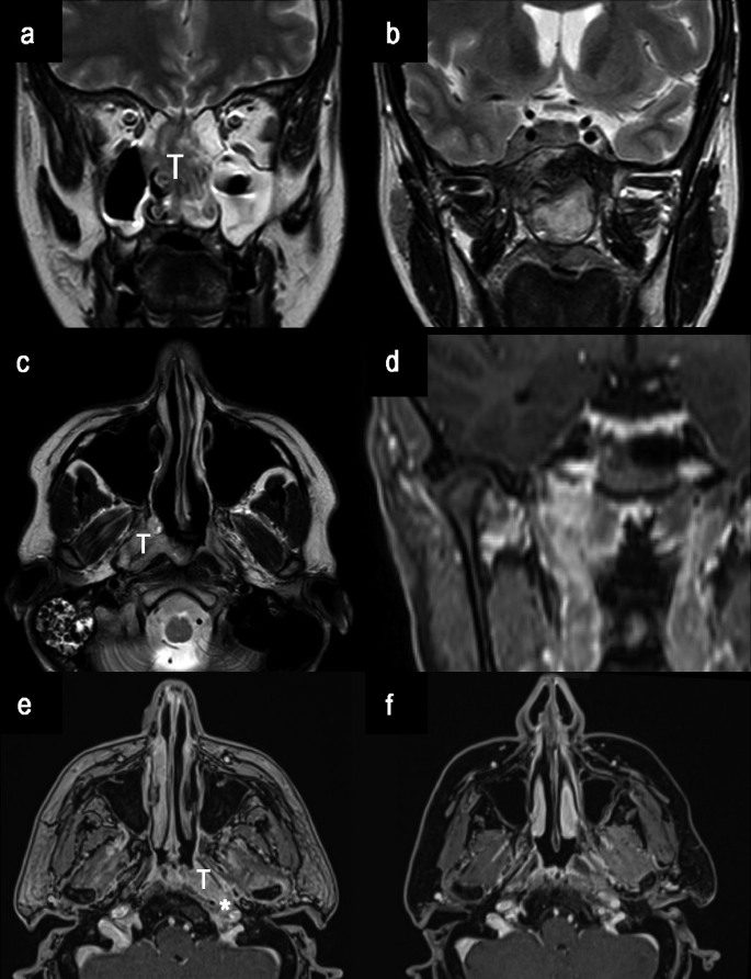 A set of six images of X-rays as Sino nasal and nasopharyngeal consists of the nasopharyngeal mass of the tumor to the brainstem. An arrow mark indicates a cavernous sinus and carotid artery.