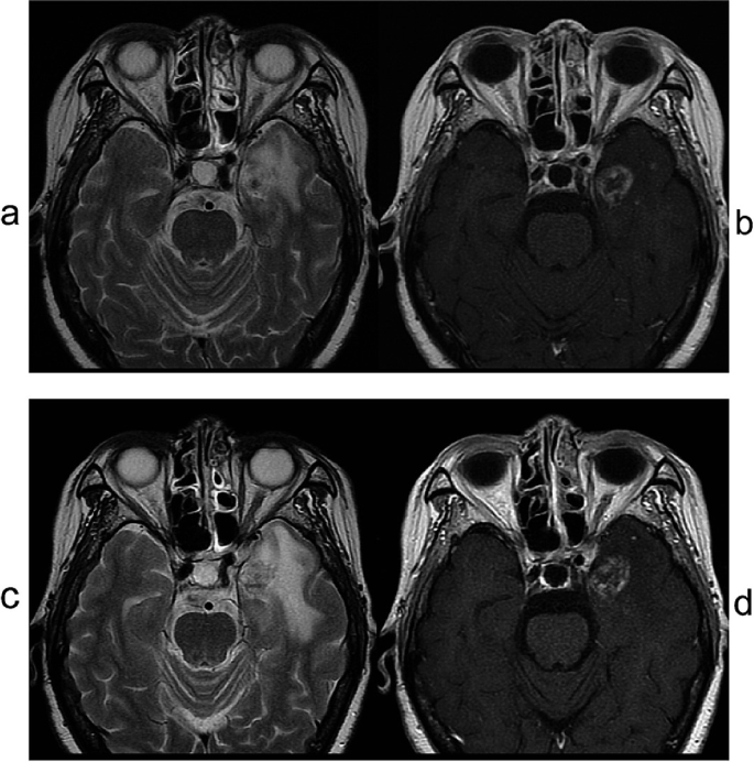 4 M R I images of a temporal lobe in axial view labeled a, b, c, and d.