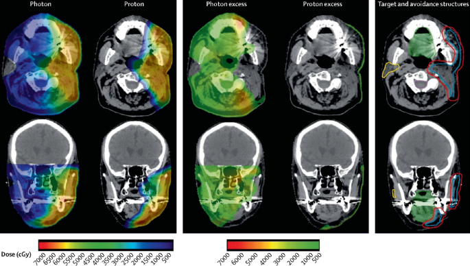 A set of three M R I scans of the head depict the post operative R T plans. First set has 2 axial and 2 anterior view of photon and proton dose distribution. Middle set has 2 axial and 2 anterior view of photon excess and proton excess. Last set has an axial and anterior view of target and avoidance structures.
