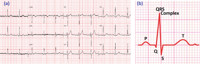 2 images labeled A and B. A has 3 E C G signals with several peaks and dips. And B has a zoomed-in view of a signal with the peaks and dips labeled Q R S complex, P, T, Q, and S.