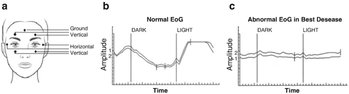 3 images labeled A, B, and C. A has a diagram of the human face with the E O G electrode position marked as Ground, Vertical, Horizontal, and Vertical above and below the eyes. B has a normal E O G signal of amplitude versus time with 2 vertical lines of Dark and Light and a fluctuating curve. And C has an abnormal E O G signal of amplitude versus time with 2 vertical lines of Dark and Light and a constant trend.