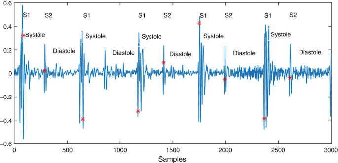 A graph of data versus samples has fluctuating curves with higher sharp peaks for systole and lower sharp peaks for diastole.