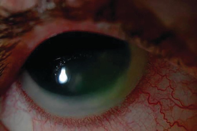 Acanthamoeba Keratitis: Eyes Hurt After Taking Out Your Contacts?