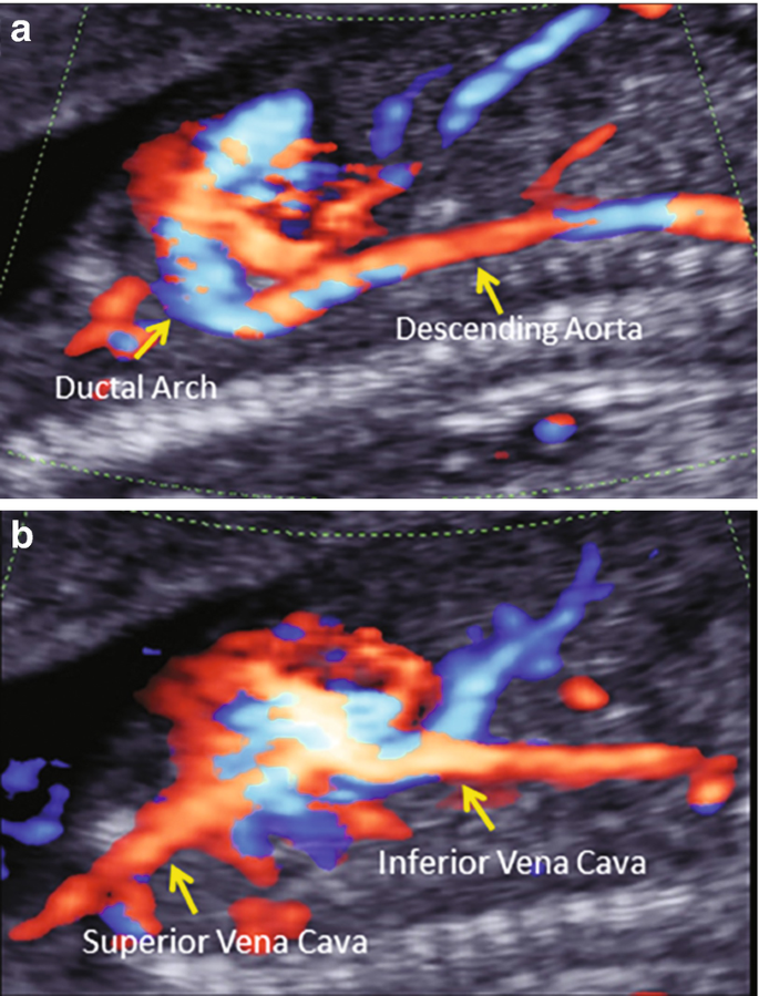 Two ultrasound scan of a fetal heart in the final days of the first trimester. With Doppler imaging, the ductal arch and descending aorta are observed in A, while the superior vena cava and inferior vena cava are observed in B.