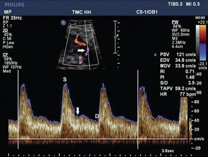 A sonographic scan of the uterine artery doppler. Some labeled parts are the M P, T M C H H, and C 5 1 or O B 1.