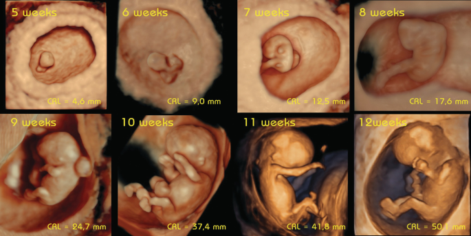 Three-Dimensional Ultrasound: A Role in Early Pregnancy? | SpringerLink