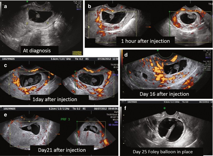 6 scan images. a to f are color doppler images at diagnosis, after 1 hour, 1 day, 16, and 21 days of injection. F indicates the foley balloon in place at day 25.