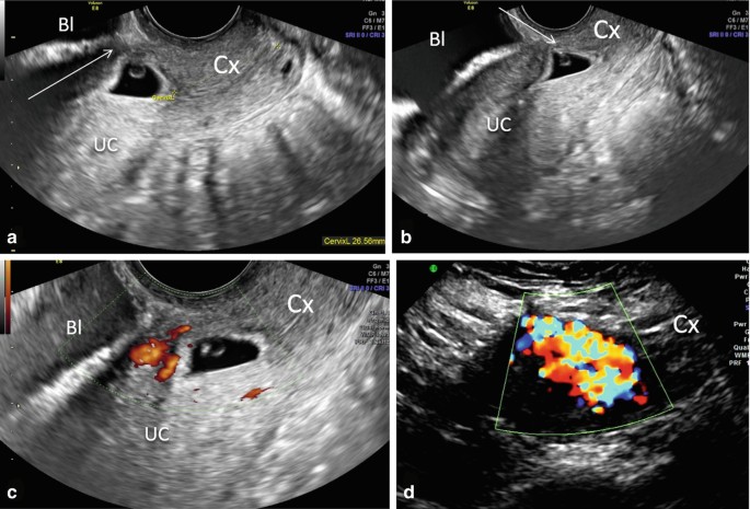 4 scan images a to d. a, b, and c ultrasounds marks B I, Cervix, and Uterine Cavity. D is a color doppler sonography has some color patches.