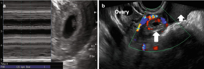 3 scans. A, the fetal heart rate is 120 beats per minute. A gestational sac with a yolk sac. B, scan of the uterus, long arrow points at a hypoechoic mass below the sac. The small arrow points to hemorrhagic fluid. Some parts around the gestational sac are highlighted in different shades.