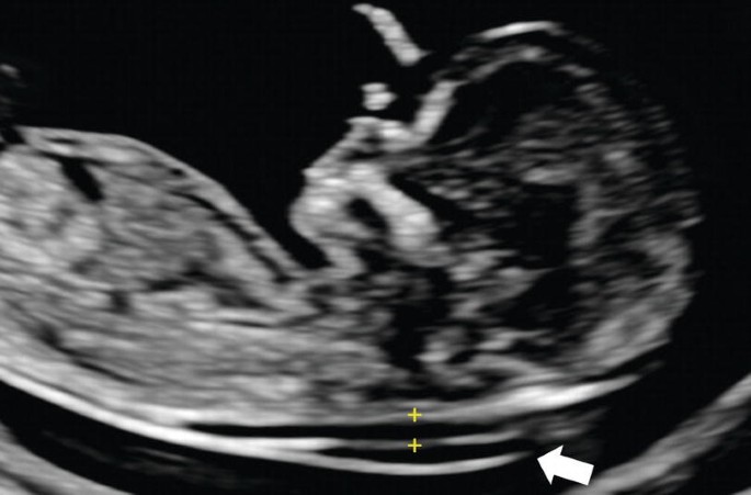 A scan of the head and upper thorax of the fetus. Nuchal translucency is marked between 2 calipers, behind the neck.